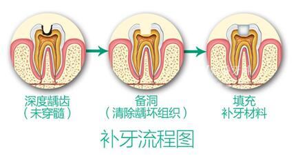 重庆诚嘉口腔医院介绍补牙材料-复合树脂(图1)