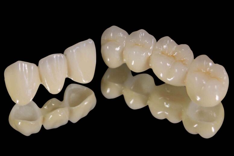 烤瓷牙与全瓷牙有什么区别？(图1)