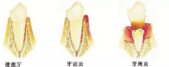 牙龈天天在萎缩！牙龈萎缩了该怎么办？(图2)