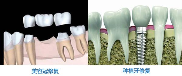 种植牙齿好用吗 老年人能种植牙齿吗(图1)