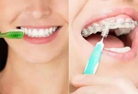 牙齿矫正器隐形牙套、钢托槽、陶瓷托槽有什么区别？(图4)