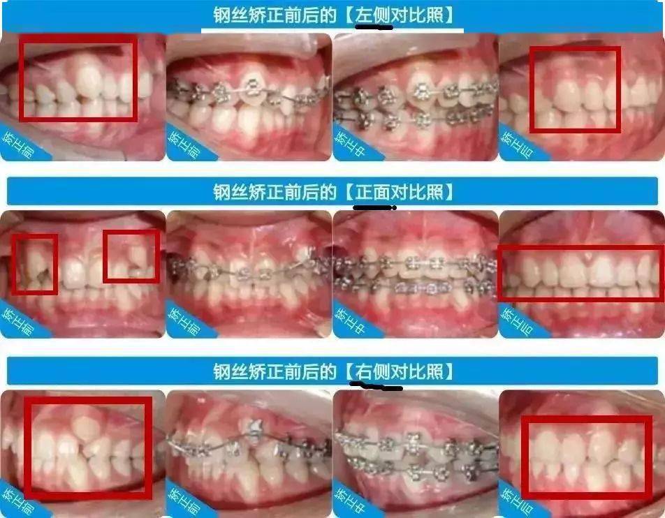 钢丝矫正和隐形矫正有什么区别？(图1)