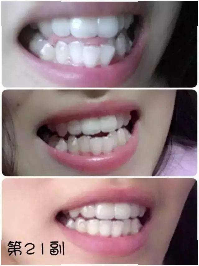 钢丝矫正和隐形矫正有什么区别？(图3)
