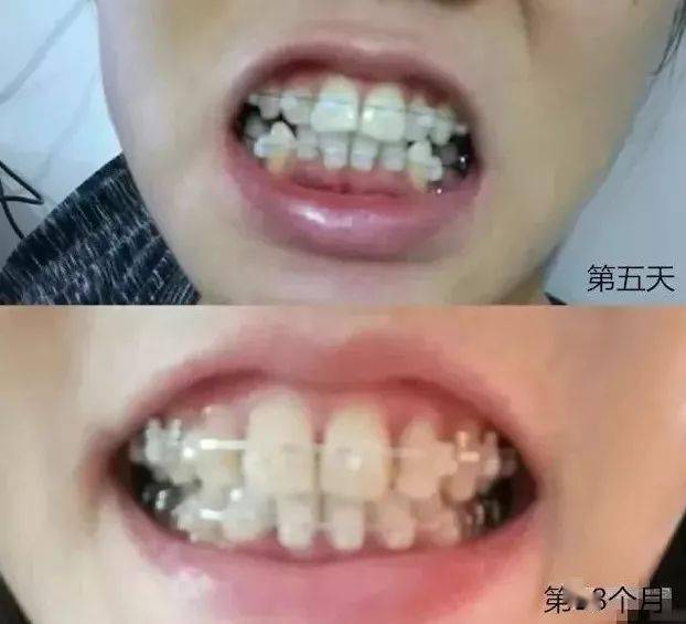 钢丝矫正和隐形矫正有什么区别？(图2)