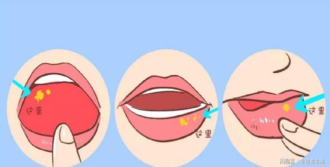 有一种痛，叫口腔溃疡：补充维C不顶用，3种药物或许更靠谱(图4)