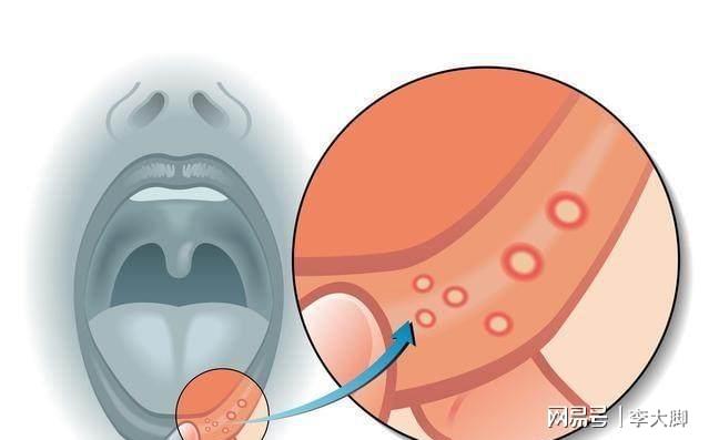 口腔溃疡感觉不起眼，疼起来真要命，要用什么药才好呢？(图4)