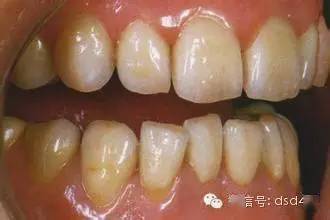 个性义齿的美学意义(图1)