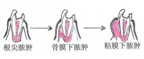 根据牙疼的症状快速找到牙疼真正的原因(图7)