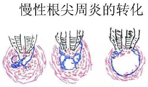 根据牙疼的症状快速找到牙疼真正的原因(图6)