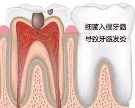 根据牙疼的症状快速找到牙疼真正的原因(图4)