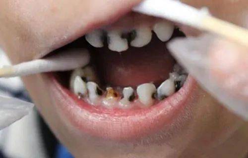 你知道导致龋齿的原因有哪些吗？(图2)