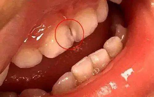 你知道导致龋齿的原因有哪些吗？(图3)