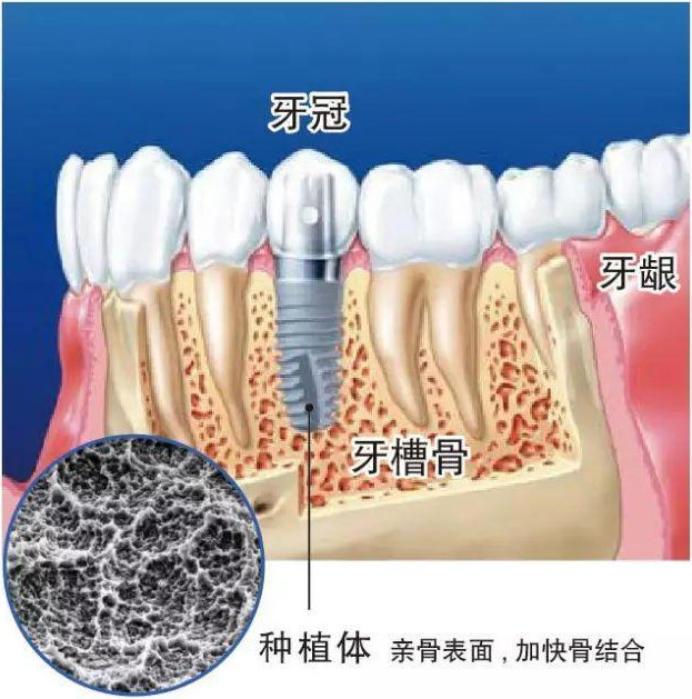 老年人遇到牙齿缺失的问题，咋办？(图3)