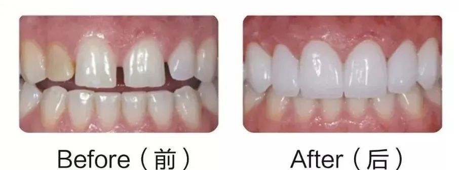 牙齿缺损、缺失以及牙齿不美观修复方式有哪些？(图8)