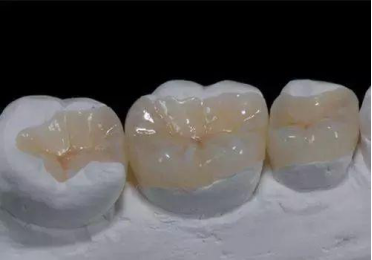牙齿缺损、缺失以及牙齿不美观修复方式有哪些？(图5)