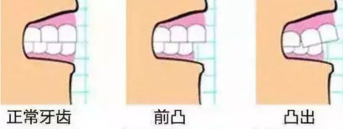  牙齿矫正你最担心的2件事你知道吗？(图3)