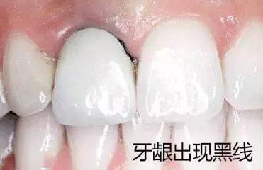 当你的烤瓷牙出现这种情况时必须拆掉！(图1)