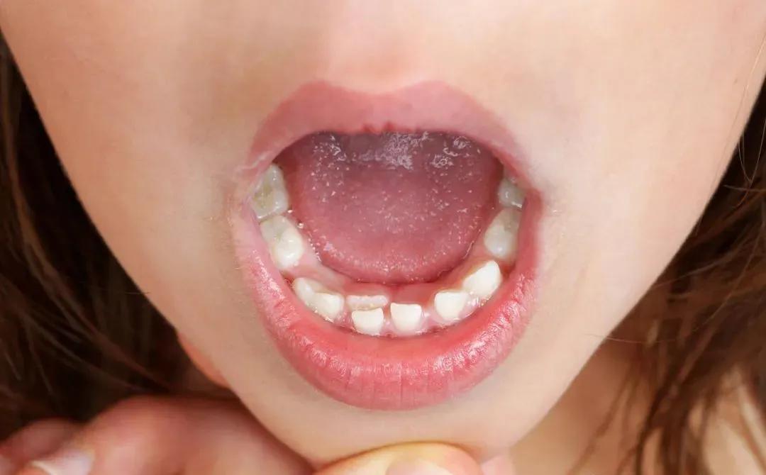 如何正确应对儿童牙齿畸形？(图1)