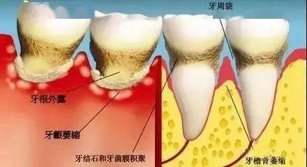 预防牙龈方面的疾病，洗牙很重要(图3)