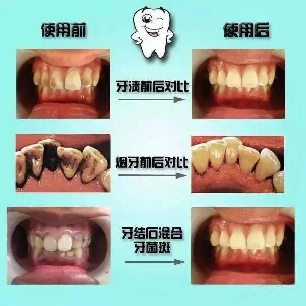 预防牙龈方面的疾病，洗牙很重要(图2)