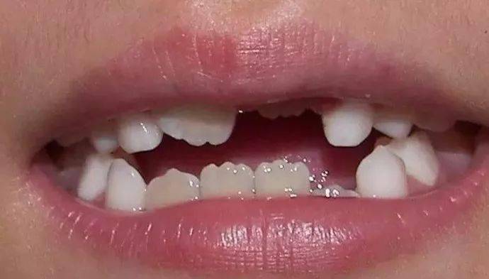 孩子新换的门牙出现锯齿状？这是什么原因？(图3)