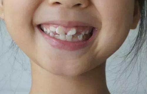 孩子新换的门牙出现锯齿状？这是什么原因？(图1)