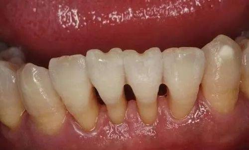 牙龈萎缩是什么原因造成的？(图1)
