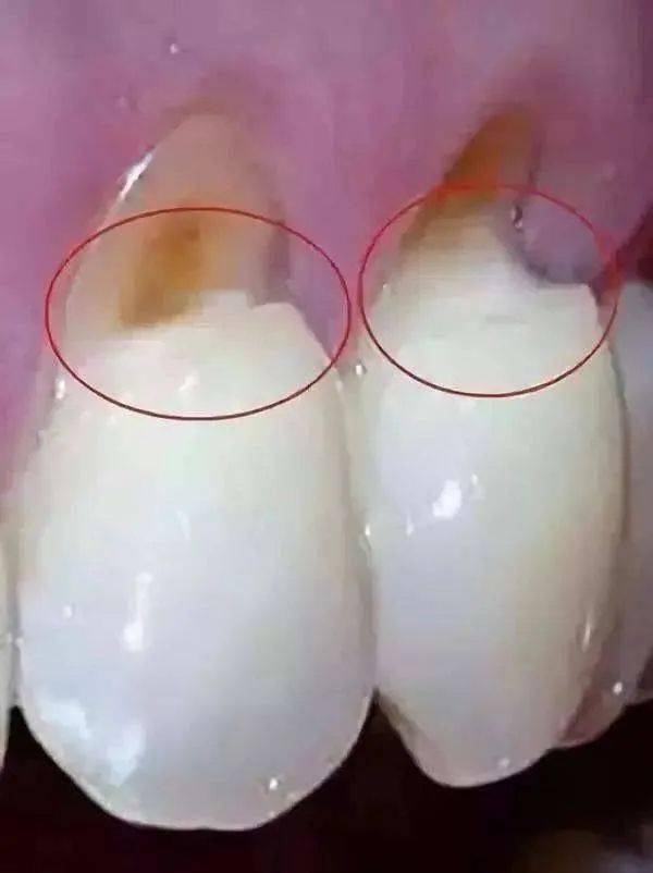 牙龈萎缩是什么原因造成的？(图6)