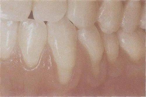 牙龈萎缩是什么原因造成的？(图2)