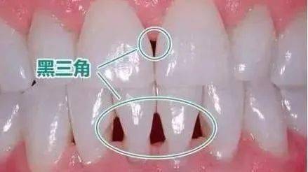 牙龈萎缩是什么原因造成的？(图4)