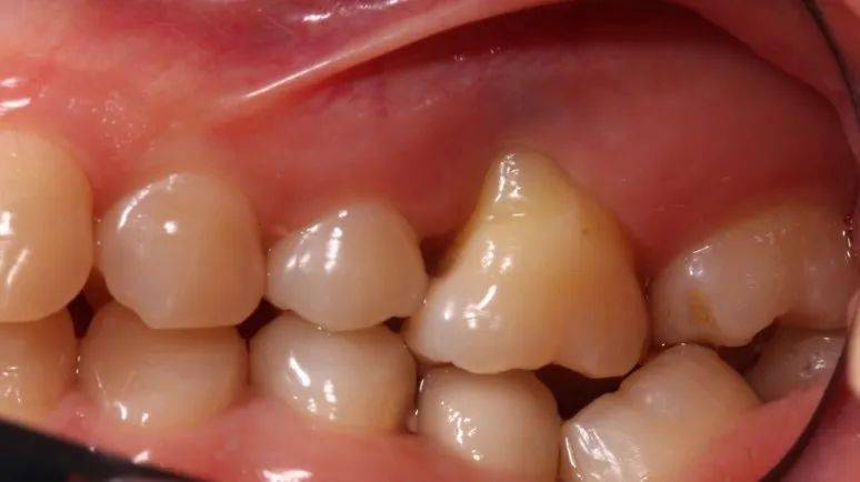 牙龈萎缩是什么原因造成的？(图3)