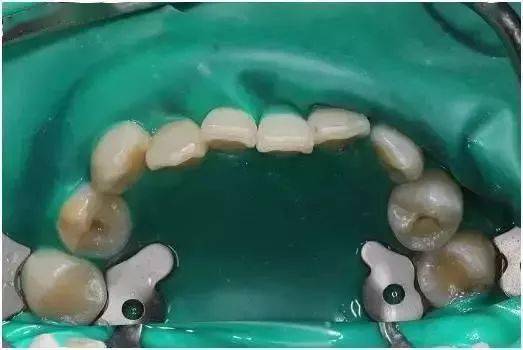 牙医：使用橡皮障有什么优点？(图1)