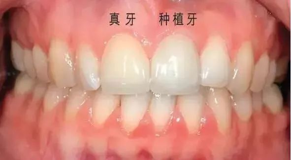 牙种植体同位点再植临床考量(图1)