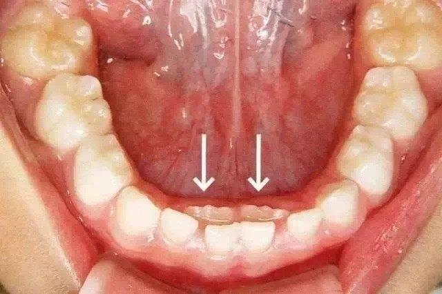 孩子出现双排牙该怎么办呢