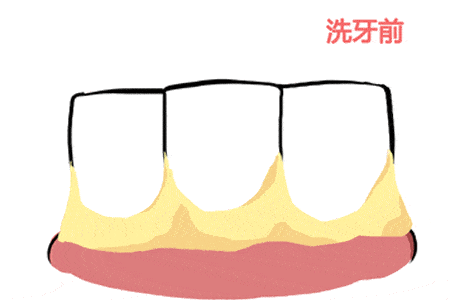 为什么医生要建议做“龈下刮治”？(图1)