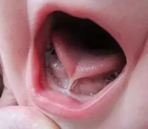 婴幼儿舌系带过短要不要剪？听医生怎么说(图1)