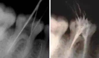 根管治疗中器械操作步骤(图5)