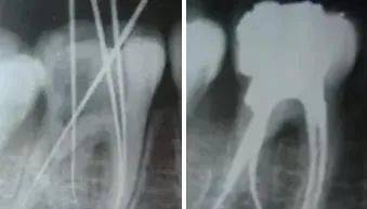 根管治疗中器械操作步骤(图13)