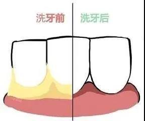 划重点：牙结石用牙刷是刷不掉的！(图1)
