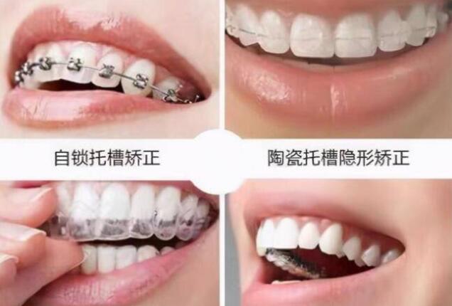 儿童牙齿矫|正郑州加齐口腔李宗周谈：儿童地包天的最佳治疗时间(图3)